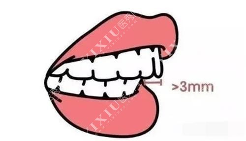 吉林桦甸矫正牙齿龅牙矫正图