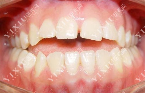 牙医回应:牙根太短能矫正牙齿吗,来看牙医如何矫正!-医秀网