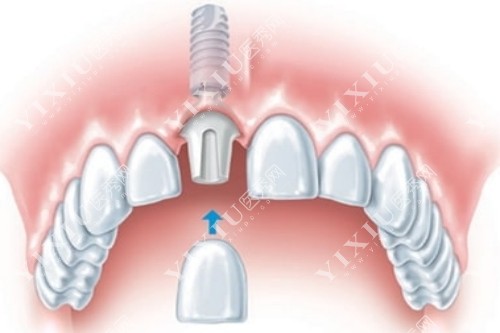 牙冠安装示意图