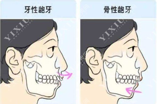 不同凸嘴类型对比