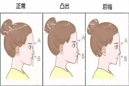 颌骨问题示意图