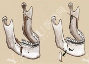 下颚骨手术示意图