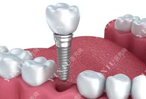 想要种植牙使用寿命更长久，这些种植牙保养方法得知道！(图1)
