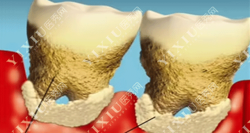 想要种植牙使用寿命更长久，这些种植牙保养方法得知道！(图4)