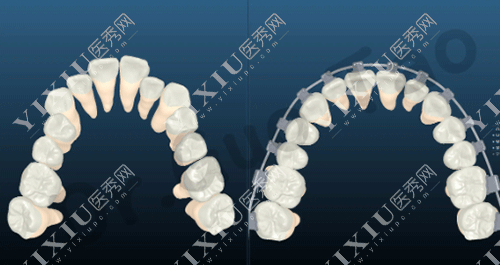 金属自锁托槽数字化矫正的图片