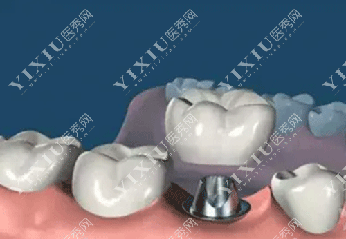 想要种植牙使用寿命更长久，这些种植牙保养方法得知道！(图3)