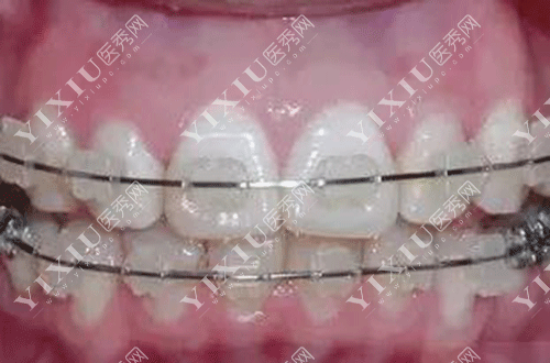 门牙假的可以矫正牙齿吗?有假牙能带牙套矫正吗?(图3) 门牙假的可以矫正牙齿吗?有假牙能带牙套矫正吗?(图3)