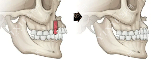 牙齿矫正骨骼的变化图片