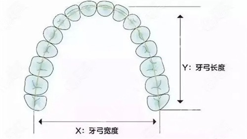 牙弓狭窄图片