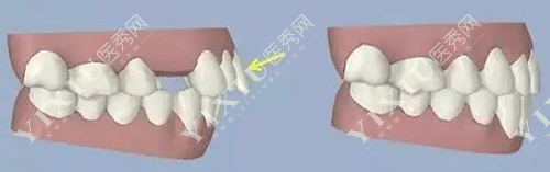 牙齿矫正的变化的图片