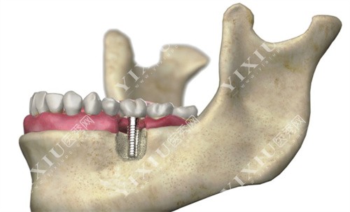 单颗种植牙<span style=