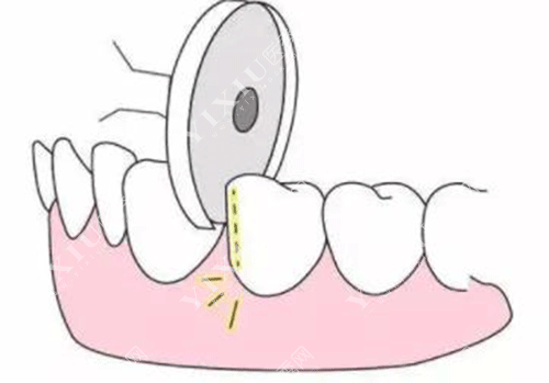 矫正牙齿医生说牙缝关不上怎么回事?科普正畸牙缝关不上原因!(图7) 矫正牙齿医生说牙缝关不上怎么回事?科普正畸牙缝关不上原因!(图7)
