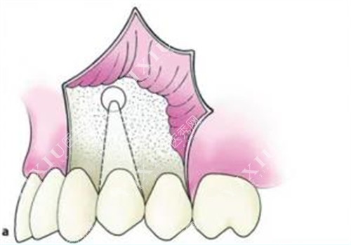 种植牙牙槽骨的图片