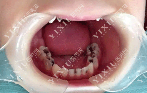 牙齿蛀牙比较多的图片