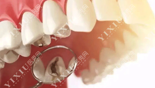 门牙太大难看怎么办?咋矫正,能磨小点吗?(图5) 门牙太大难看怎么办?咋矫正,能磨小点吗?(图5)