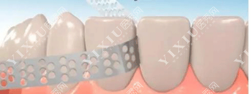 矫正牙齿医生说牙缝关不上怎么回事?科普正畸牙缝关不上原因!(图6) 矫正牙齿医生说牙缝关不上怎么回事?科普正畸牙缝关不上原因!(图6)