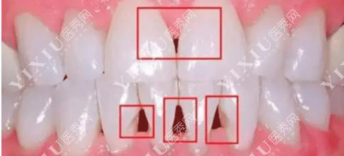 矫正牙齿医生说牙缝关不上怎么回事?科普正畸牙缝关不上原因!(图8) 矫正牙齿医生说牙缝关不上怎么回事?科普正畸牙缝关不上原因!(图8)