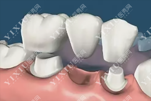 下牙安装固定桥模型示意图