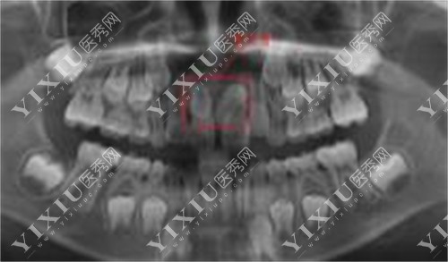 拍片检查多生牙的图片