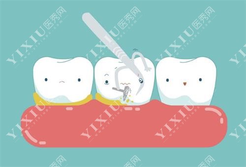 吉林爱齿口腔洗牙图