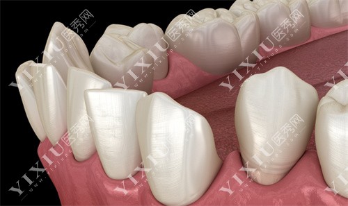 错位牙齿3D动画图