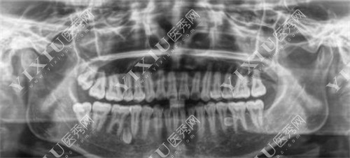 牙齿CT检查的图片