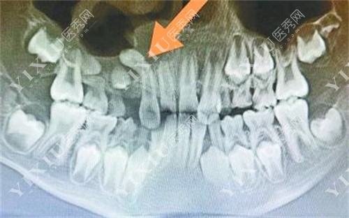 牙齿被多生牙顶歪了
