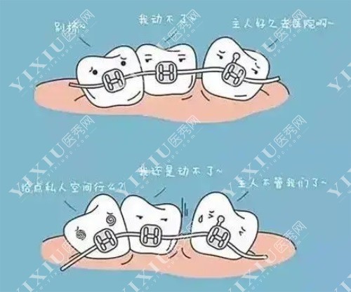 金属托槽矫正示意图