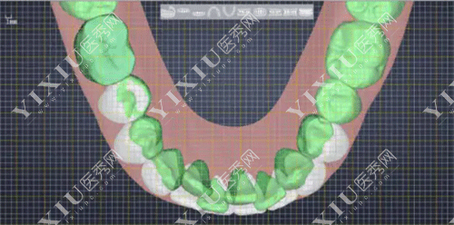 时代天使的价格一般是多少?时代天使双模版25000贵吗?(图4) 时代天使的价格一般是多少?时代天使双模版25000贵吗?(图4)