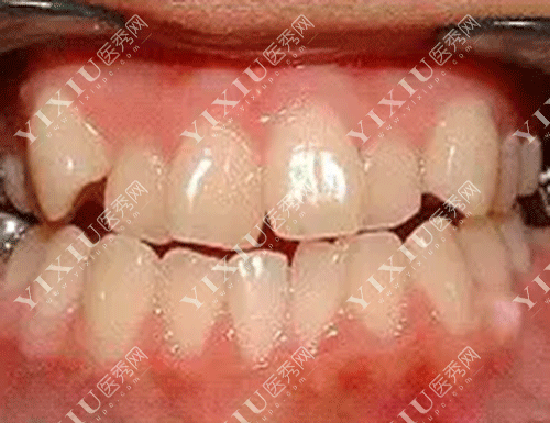 时代天使的价格一般是多少?时代天使双模版25000贵吗?(图3) 时代天使的价格一般是多少?时代天使双模版25000贵吗?(图3)