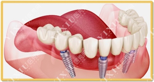 口腔种植牙示意图