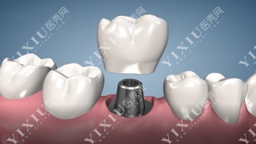 种植牙牙冠示意图
