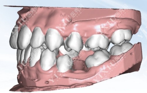 牙齿不整齐建模图
