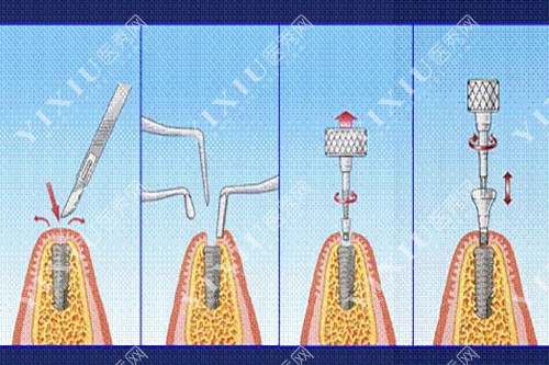 种植牙手术简单过程示意图