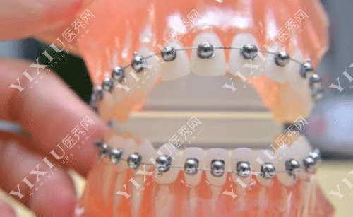 ormco金属自锁托槽价格是多少?详解奥美科金属托槽优势附牙友反馈!(图5) ormco金属自锁托槽价格是多少?详解奥美科金属托槽优势附牙友反馈!(图5)