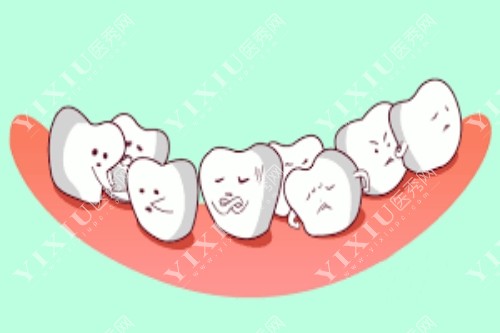 卡通牙列拥挤示意图