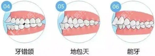 各类牙齿畸形示意图