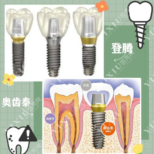 奥齿泰和登腾种植牙照片