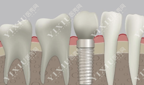 黄冈皓清齿科怎么样？想要种牙好和矫正疑难牙齿问题就来这里！(图5)