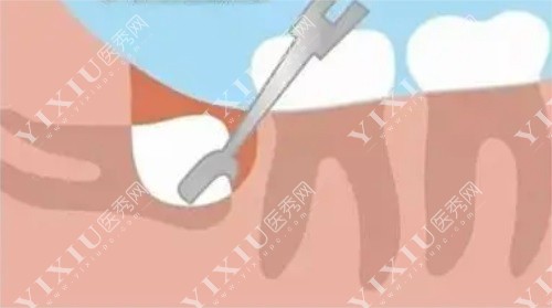 详解凯里拔智齿多少钱一颗？凯里拔智齿哪家牙科医院好？(图1)