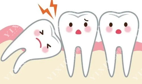 详解凯里拔智齿多少钱一颗？凯里拔智齿哪家牙科医院好？(图2)