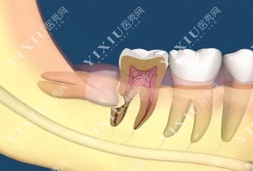 详解凯里拔智齿多少钱一颗？凯里拔智齿哪家牙科医院好？(图3)