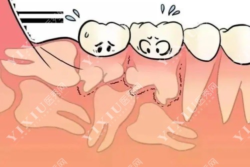 详解凯里拔智齿多少钱一颗？凯里拔智齿哪家牙科医院好？(图4)