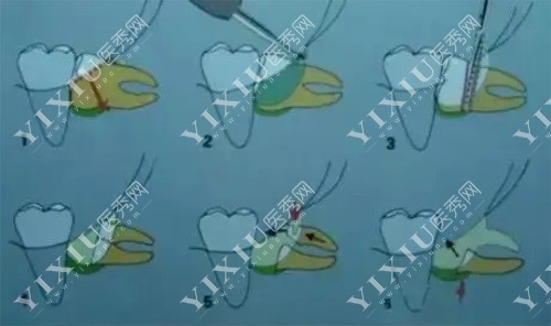 详解凯里拔智齿多少钱一颗？凯里拔智齿哪家牙科医院好？(图5)