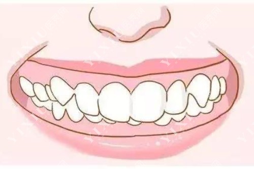 牙齿畸形卡通示意图