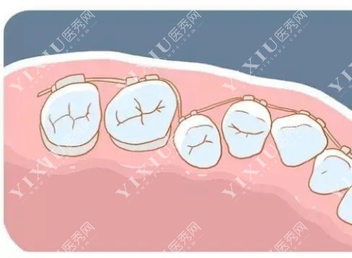 唇侧金属矫治器卡通示意图