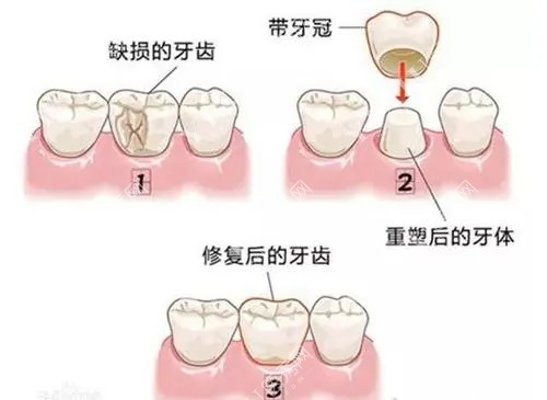 牙冠修复缺损牙体过程示意图