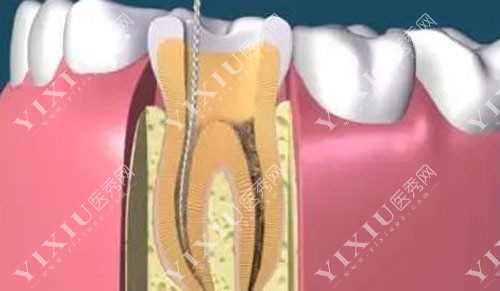 牙齿根管治疗卡通示意图
