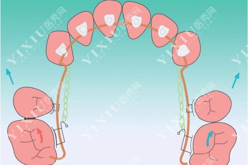 牙齿矫正卡通示意图