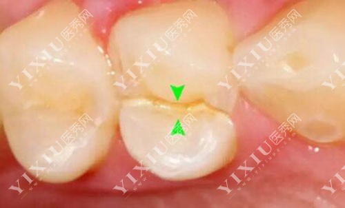 后磨牙出现牙隐裂展示